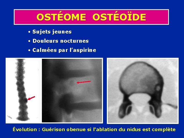 OSTÉOME OSTÉOÏDE • Sujets jeunes • Douleurs nocturnes • Calmées par l’aspirine Évolution :