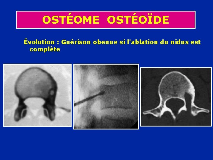 OSTÉOME OSTÉOÏDE Évolution : Guérison obenue si l'ablation du nidus est complète 