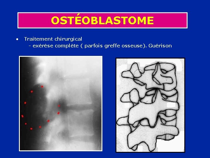 OSTÉOBLASTOME • Traitement chirurgical - exérèse complète ( parfois greffe osseuse). Guérison 