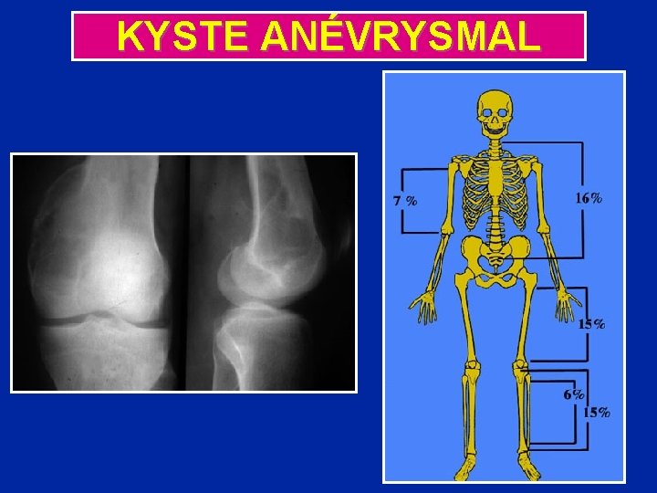 KYSTE ANÉVRYSMAL 