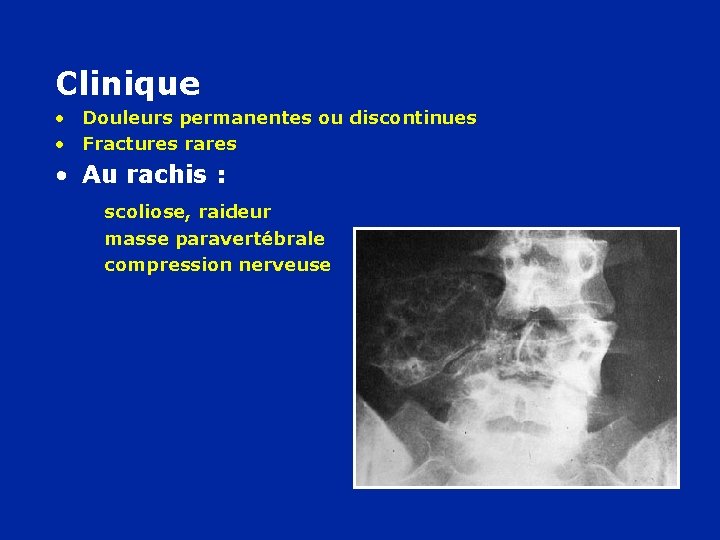 Clinique • Douleurs permanentes ou discontinues • Fractures rares • Au rachis : scoliose,