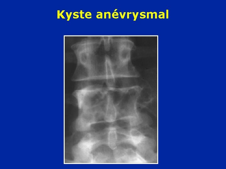 Kyste anévrysmal 