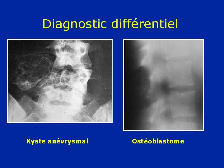 Diagnostic différentiel Kyste anévrysmal Ostéoblastome 