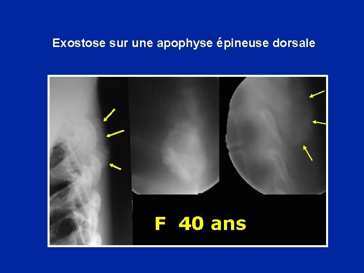 Exostose sur une apophyse épineuse dorsale F 40 ans 