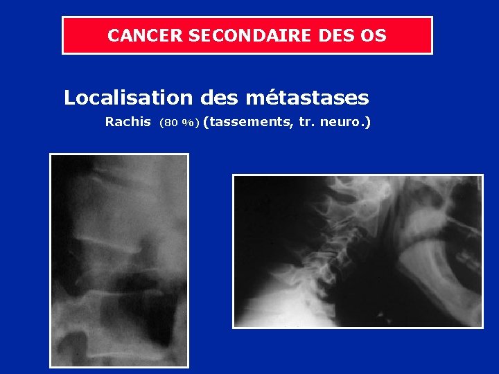 CANCER SECONDAIRE DES OS Localisation des métastases Rachis (80 %) (tassements, tr. neuro. )