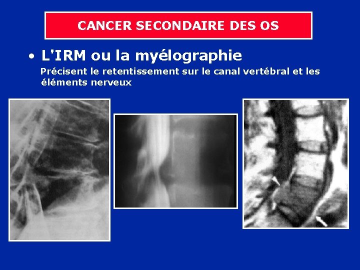 CANCER SECONDAIRE DES OS • L'IRM ou la myélographie Précisent le retentissement sur le