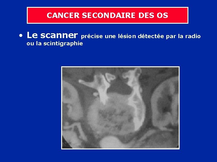 CANCER SECONDAIRE DES OS • Le scanner précise une lésion détectée par la radio