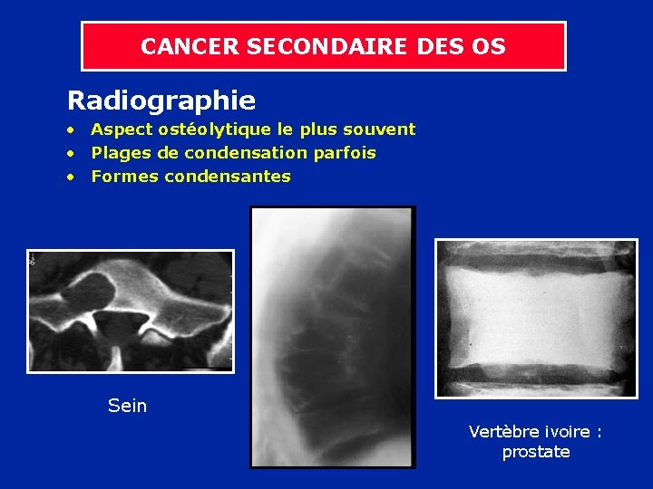 CANCER SECONDAIRE DES OS Radiographie • Aspect ostéolytique le plus souvent • Plages de