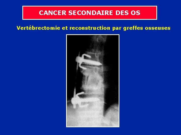 CANCER SECONDAIRE DES OS Vertébrectomie et reconstruction par greffes osseuses 