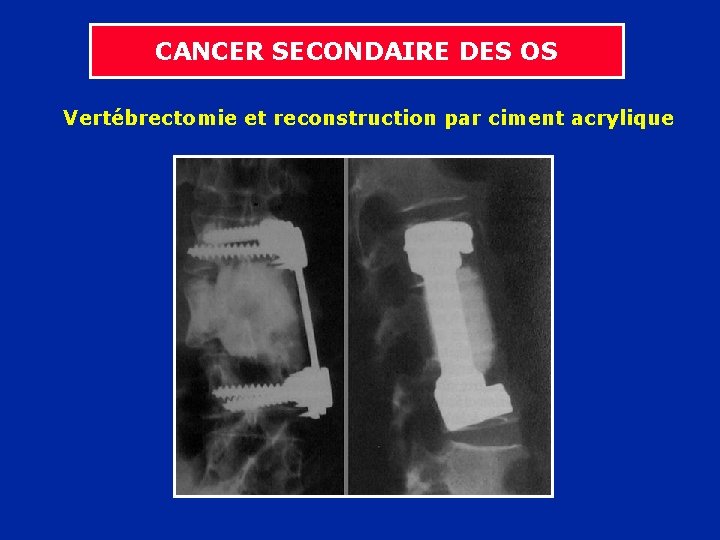 CANCER SECONDAIRE DES OS Vertébrectomie et reconstruction par ciment acrylique 