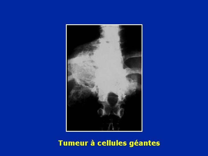 Tumeur à cellules géantes 