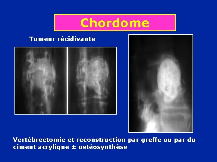 Chordome Tumeur récidivante Vertébrectomie et reconstruction par greffe ou par du ciment acrylique ±