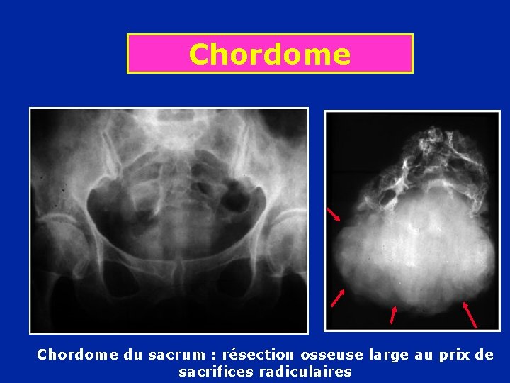 Chordome du sacrum : résection osseuse large au prix de sacrifices radiculaires 