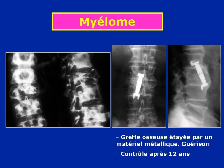 Myélome - Greffe osseuse étayée par un matériel métallique. Guérison - Contrôle après 12