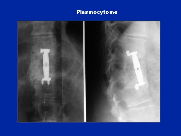 Plasmocytome 