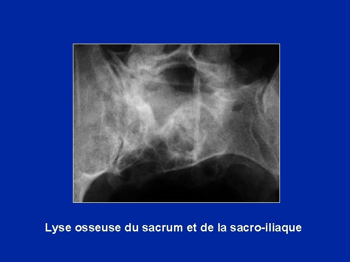 Lyse osseuse du sacrum et de la sacro-iliaque 