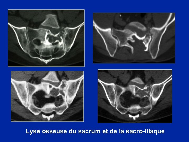 Lyse osseuse du sacrum et de la sacro-iliaque 