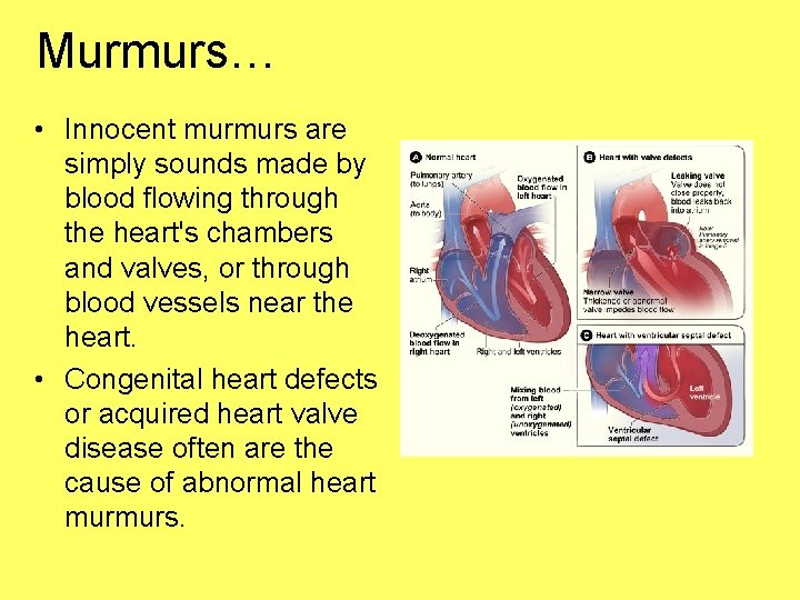 Murmurs… • Innocent murmurs are simply sounds made by blood flowing through the heart's