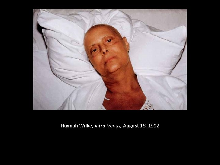 Hannah Wilke, Intra-Venus, August 18, 1992 