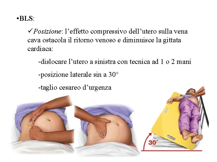  • BLS: üPosizione: l’effetto compressivo dell’utero sulla vena cava ostacola il ritorno venoso