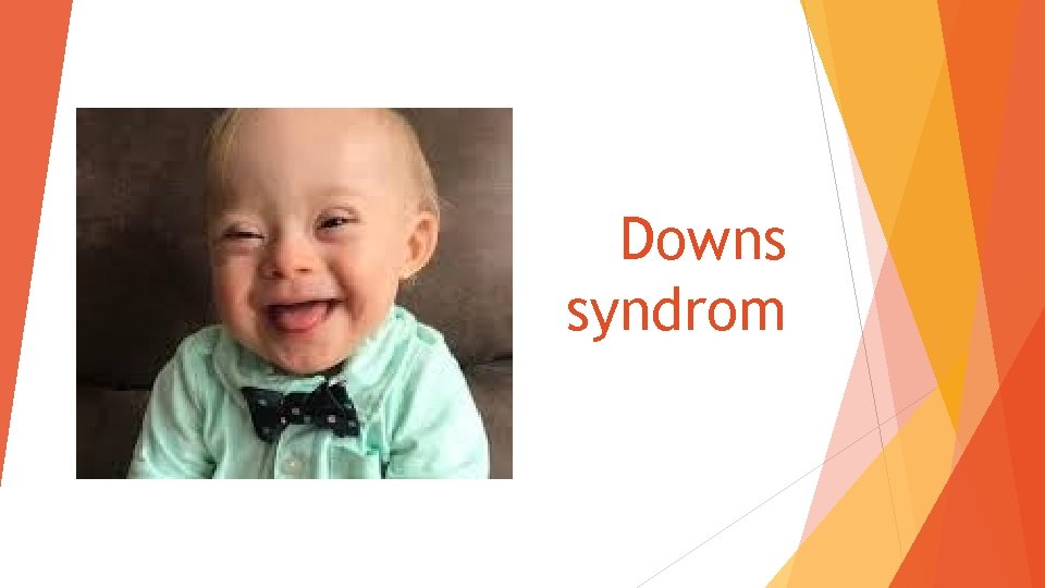 Downs syndrom 