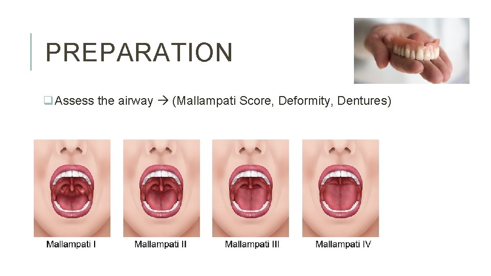 PREPARATION q. Assess the airway (Mallampati Score, Deformity, Dentures) 