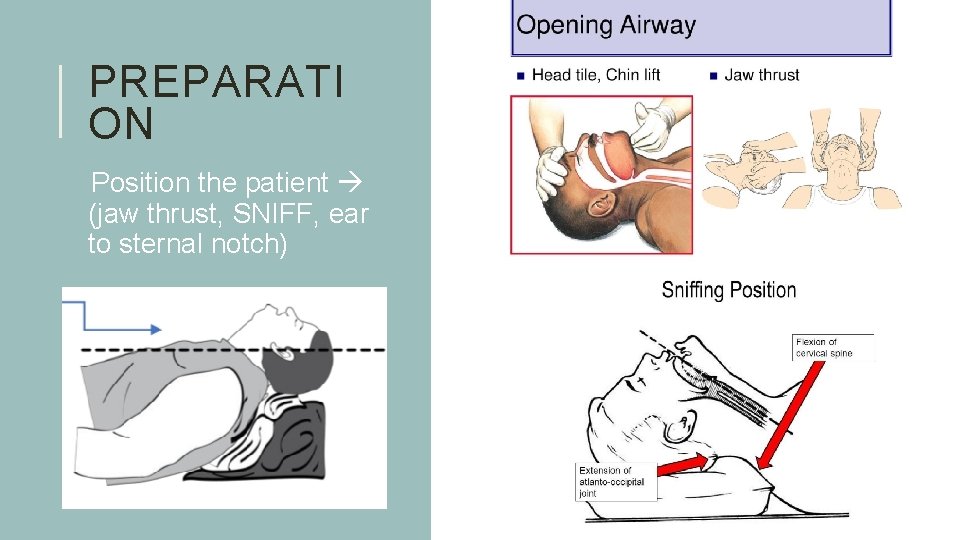 PREPARATI ON q. Position the patient (jaw thrust, SNIFF, ear to sternal notch) 