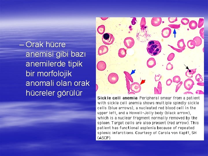 – Orak hücre anemisi gibi bazı anemilerde tipik bir morfolojik anomali olan orak hücreler – Orak hücre anemisi gibi bazı anemilerde tipik bir morfolojik anomali olan orak hücreler