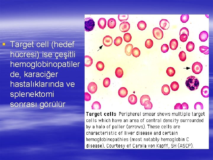 § Target cell (hedef hücresi) ise çeşitli hemoglobinopatiler de, karaciğer hastalıklarında ve splenektomi sonrası