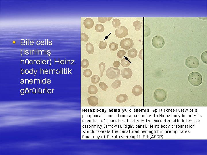 § Bite cells (ısırılmış hücreler) Heinz body hemolitik anemide görülürler 