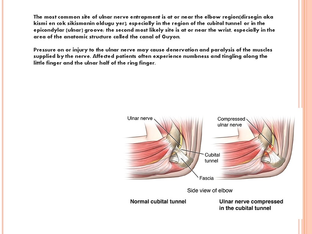 The most common site of ulnar nerve entrapment is at or near the elbow