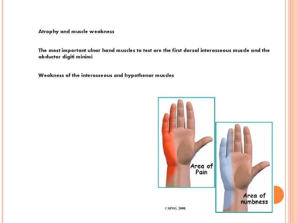 Atrophy and muscle weakness The most important ulnar hand muscles to test are the
