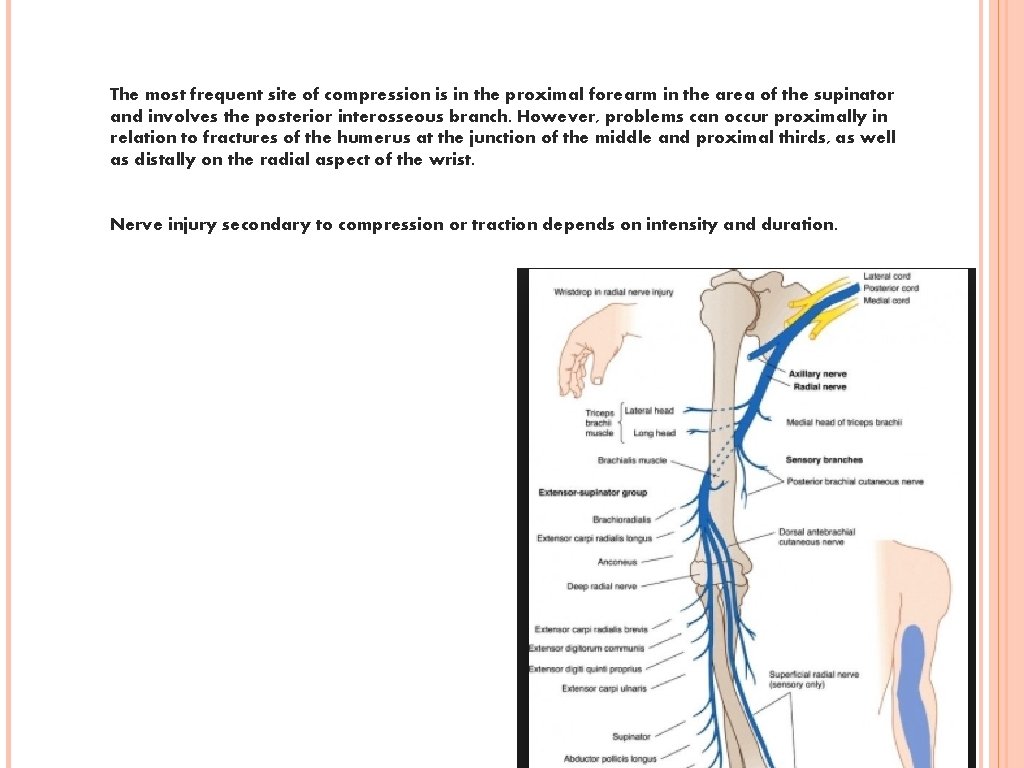 The most frequent site of compression is in the proximal forearm in the area