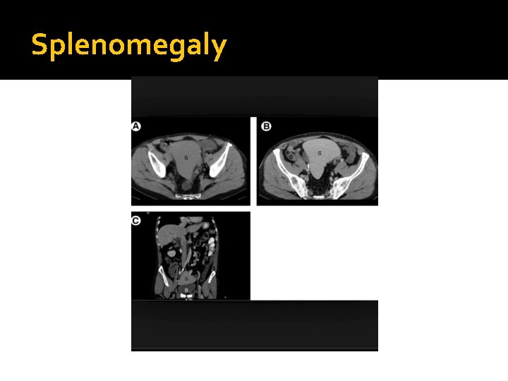 Splenomegaly 