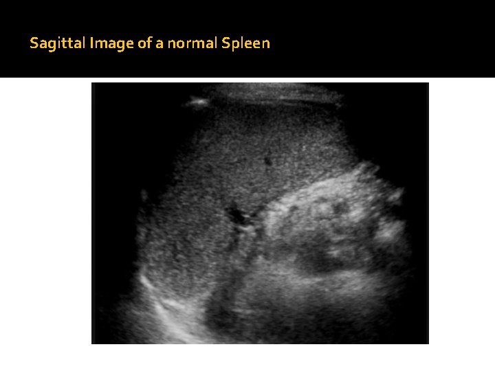 Sagittal Image of a normal Spleen 