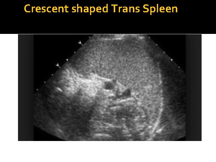 Crescent shaped Trans Spleen 