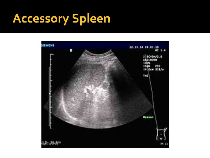 Accessory Spleen 