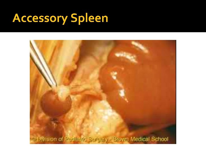 Accessory Spleen 