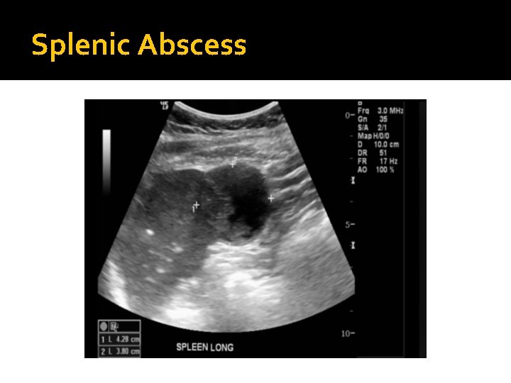 Splenic Abscess 