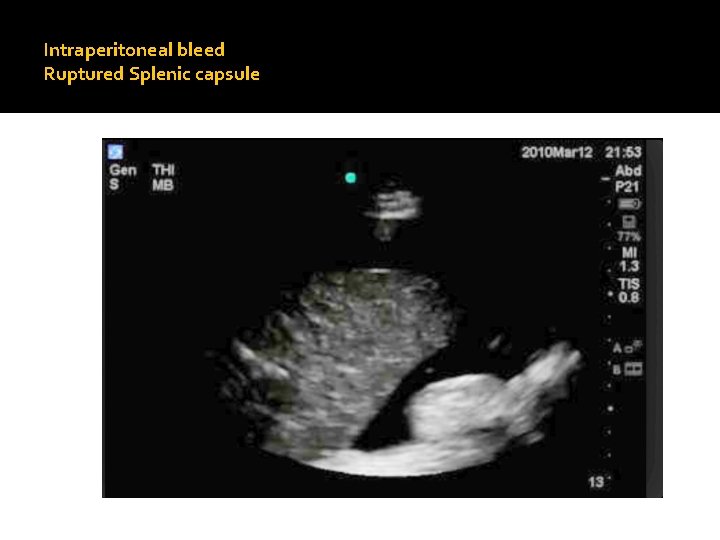 Intraperitoneal bleed Ruptured Splenic capsule 