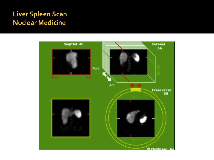 Liver Spleen Scan Nuclear Medicine 