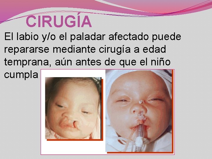 CIRUGÍA El labio y/o el paladar afectado puede repararse mediante cirugía a edad temprana,