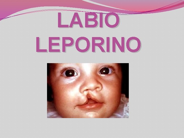 LABIO LEPORINO 