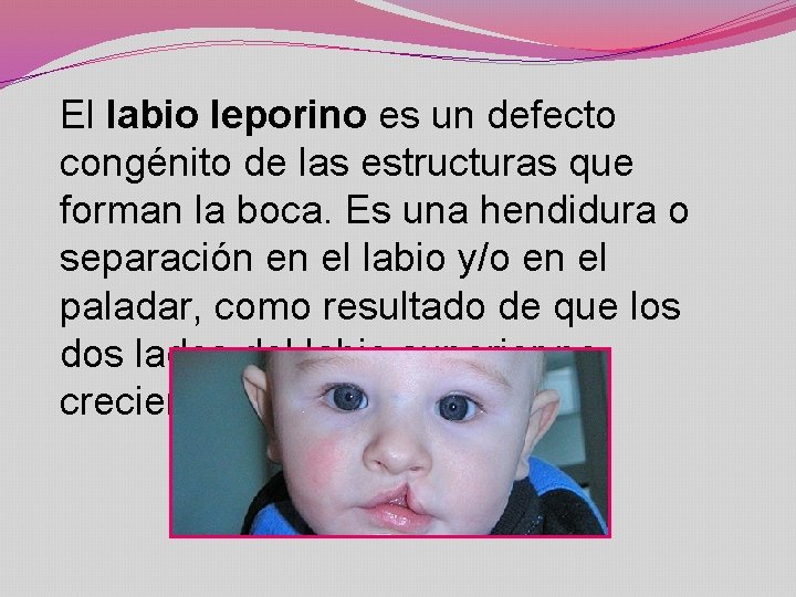 El labio leporino es un defecto congénito de las estructuras que forman la boca.