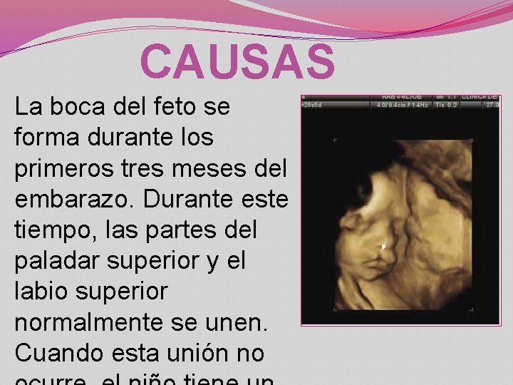 CAUSAS La boca del feto se forma durante los primeros tres meses del embarazo.