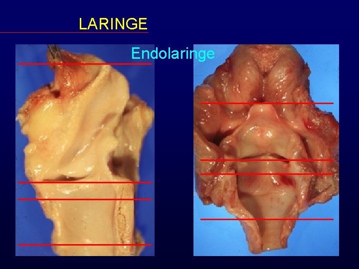 LARINGE Endolaringe 