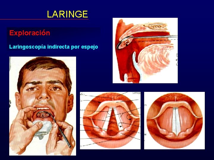 LARINGE Exploración Laringoscopía indirecta por espejo 