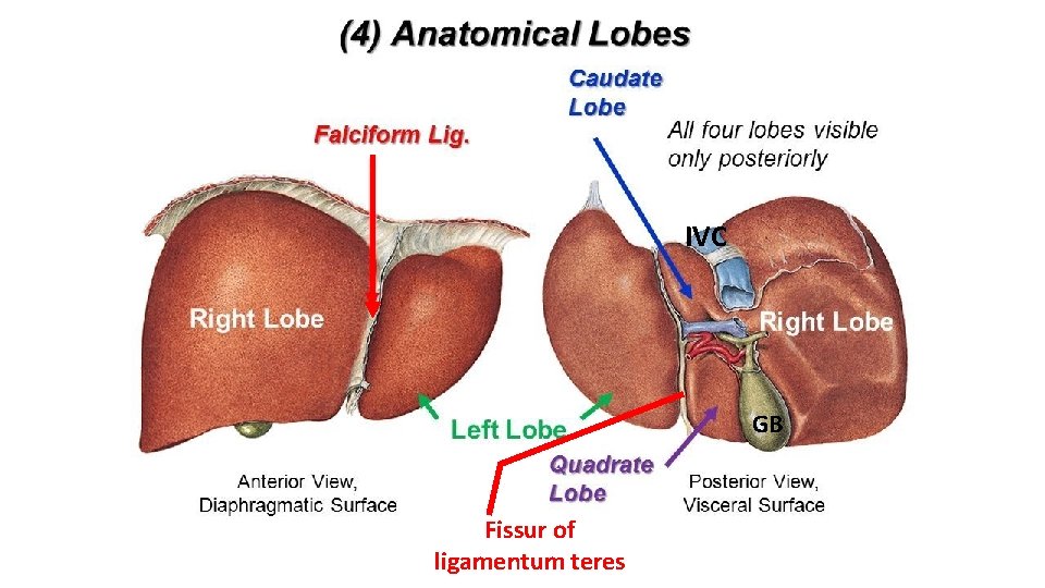 IVC GB Fissur of ligamentum teres 