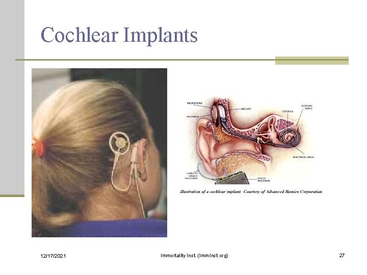Cochlear Implants 12/17/2021 Immortality Inst. (Imm. Inst. org) 27 
