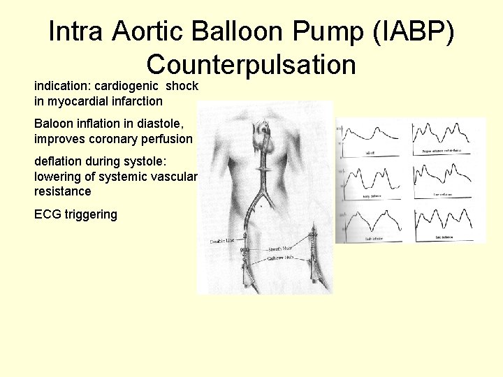 Intra Aortic Balloon Pump (IABP) Counterpulsation indication: cardiogenic shock in myocardial infarction Baloon inflation